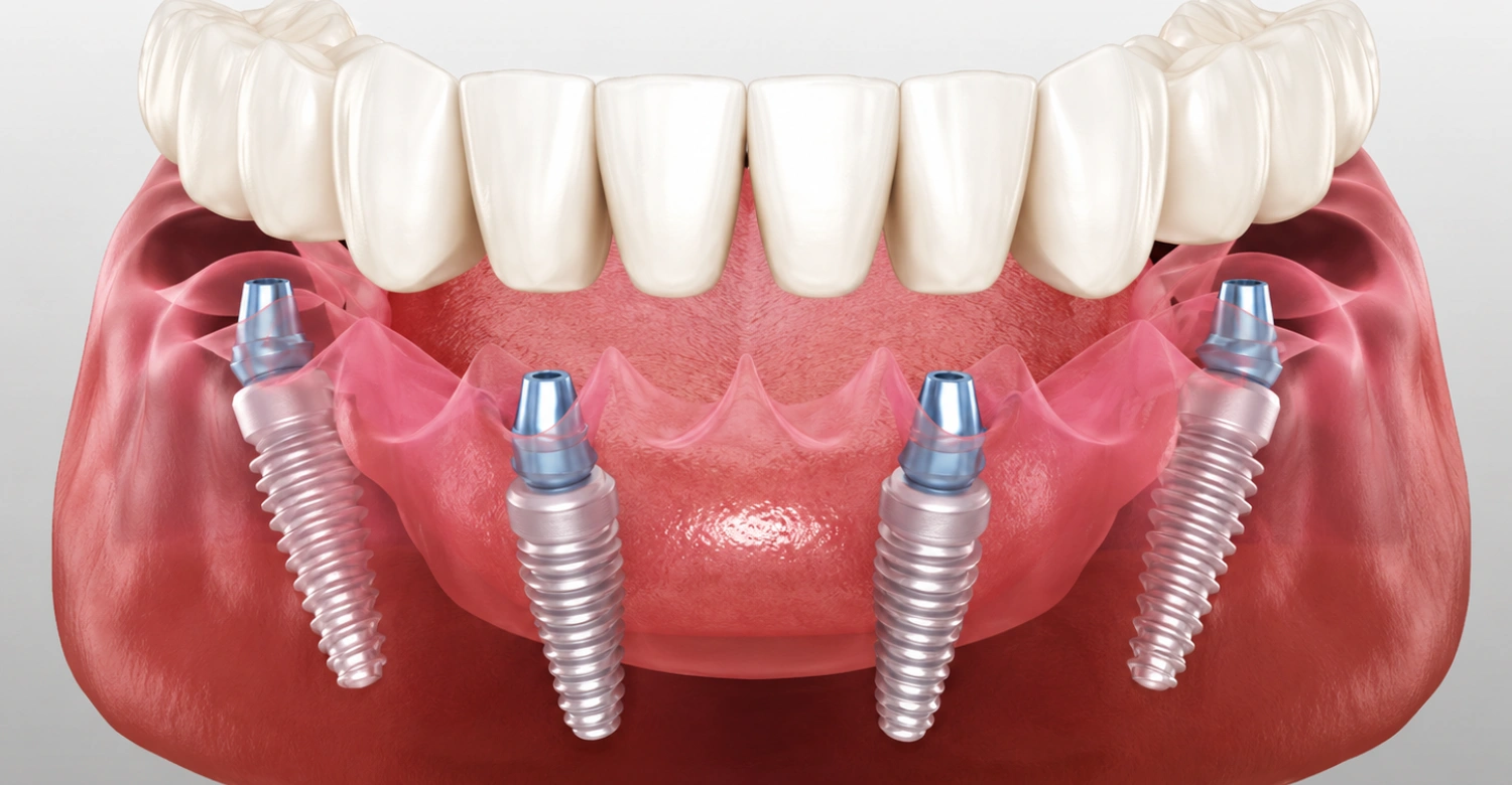 Full Mouth Dental Implants Turkey Package2 (1)